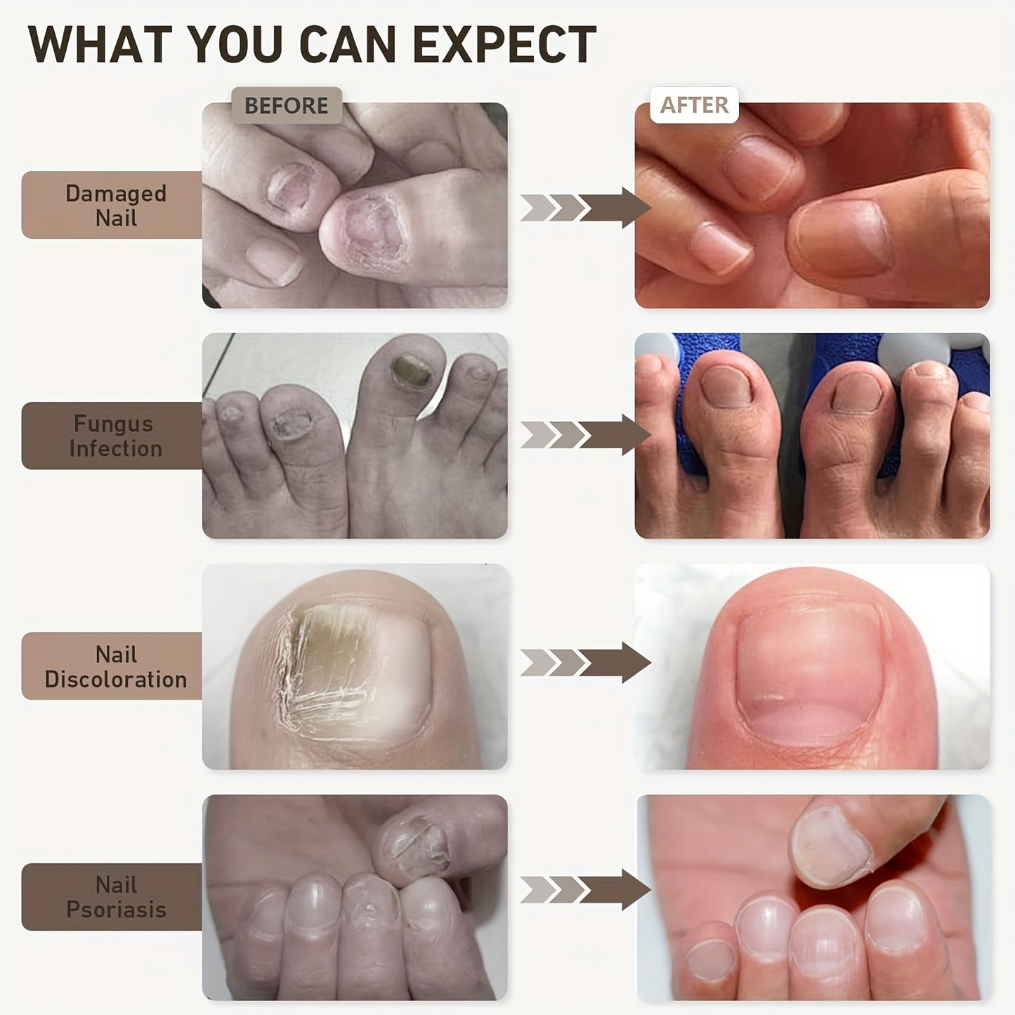 Nail Fungus Laser Upgrade Treatment Device, Adjustable Sessions Of 3/5/7/10 Minutes, Nail Laser Cleaning Fingernails & Onychomycosis, Nail Fungus Remover With 15 X 470 Nm Blue Light + 42 X 650